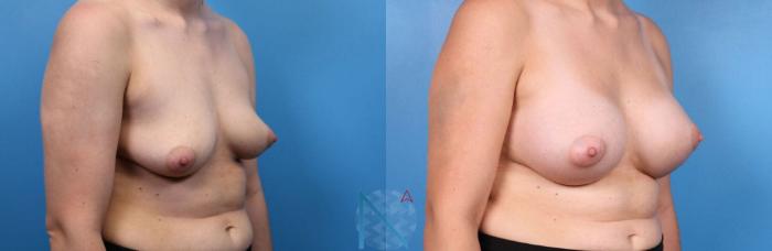 Before & After Breast Augmentation Case 41 View 2 View in Raleigh, NC