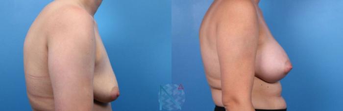 Before & After Breast Augmentation Case 41 View 3 View in Raleigh, NC