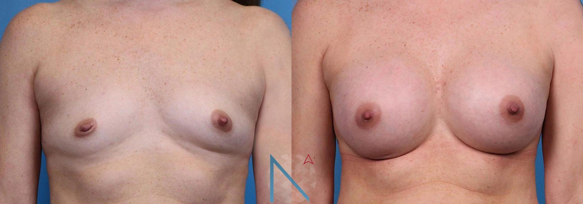 Before & After Breast Augmentation Case 42 View 1 View in Raleigh, NC