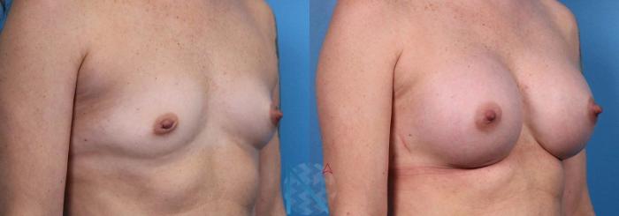 Before & After Breast Augmentation Case 42 View 2 View in Raleigh, NC