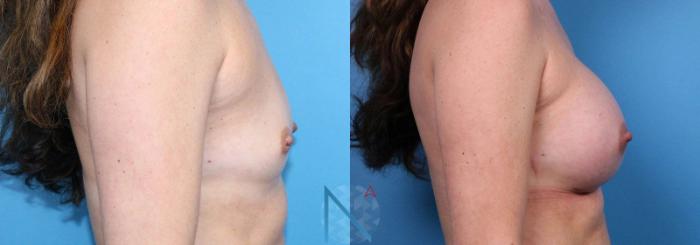 Before & After Breast Augmentation Case 42 View 3 View in Raleigh, NC