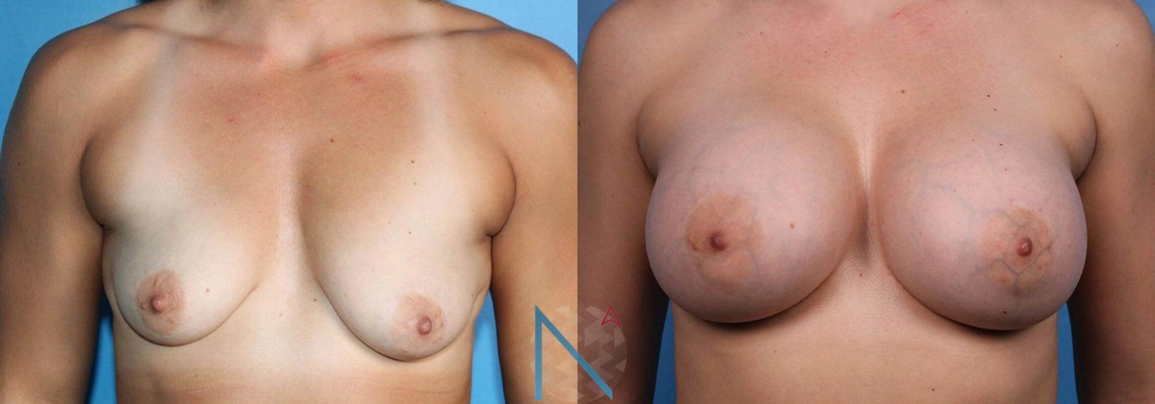 Before & After Breast Augmentation Case 43 View 1 View in Raleigh, NC