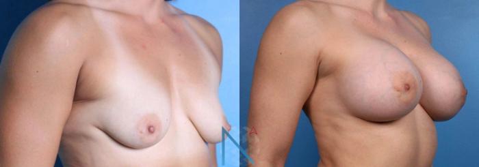 Before & After Breast Augmentation Case 43 View 2 View in Raleigh, NC