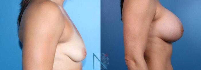 Before & After Breast Augmentation Case 43 View 3 View in Raleigh, NC