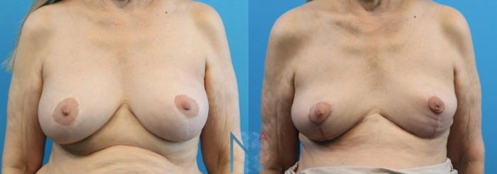 Before & After Breast Implant Removal Case 78 View 1 View in Raleigh, NC