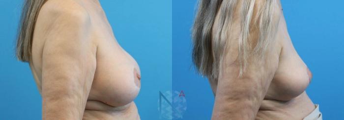 Before & After Breast Implant Removal Case 78 View 3 View in Raleigh, NC