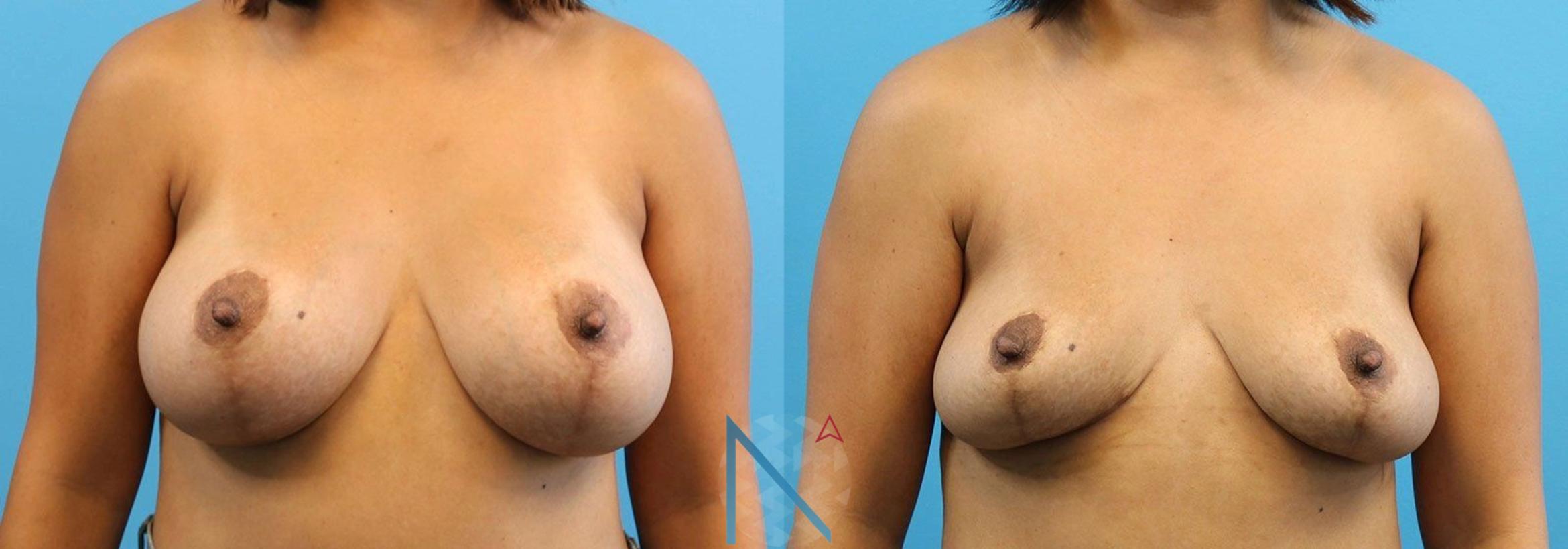 Before & After Breast Implant Removal Case 79 View 1 View in Raleigh, NC