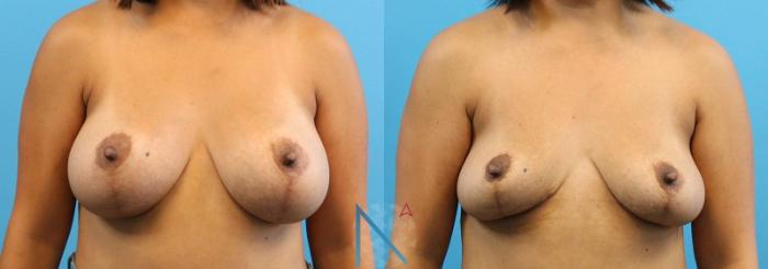 Before & After Breast Implant Removal Case 79 View 1 View in Raleigh, NC