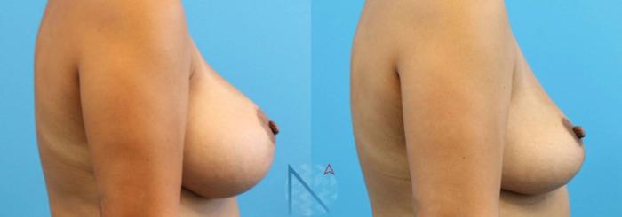 Before & After Breast Implant Removal Case 79 View 3 View in Raleigh, NC