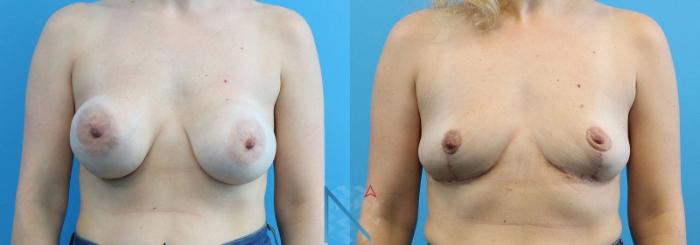 Before & After Breast Implant Removal Case 80 View 1 View in Raleigh, NC