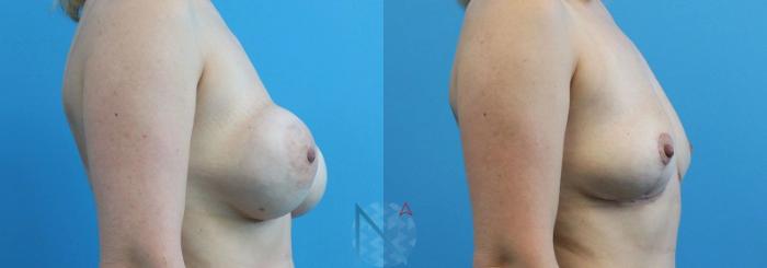 Before & After Breast Implant Removal Case 80 View 3 View in Raleigh, NC