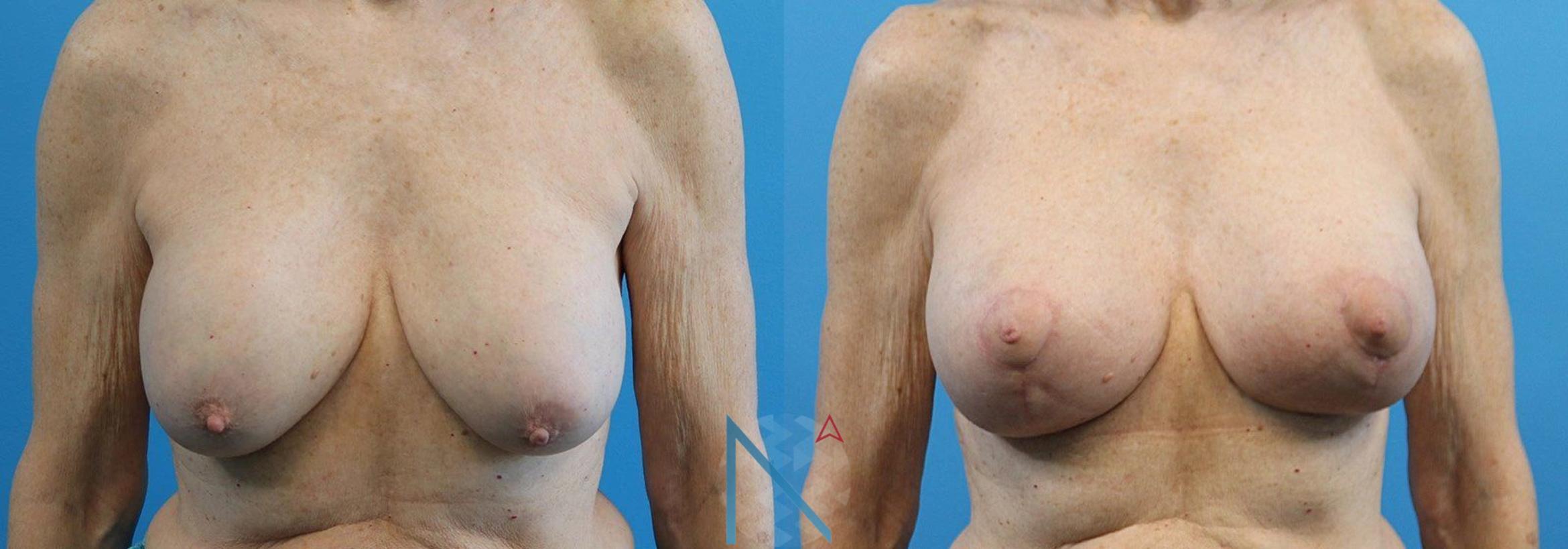 Before & After Breast Implant Revision Case 67 View 1 View in Raleigh, NC