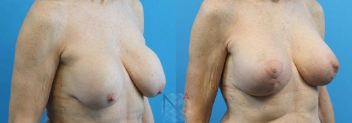 Before & After Breast Implant Revision Case 67 View 2 View in Raleigh, NC