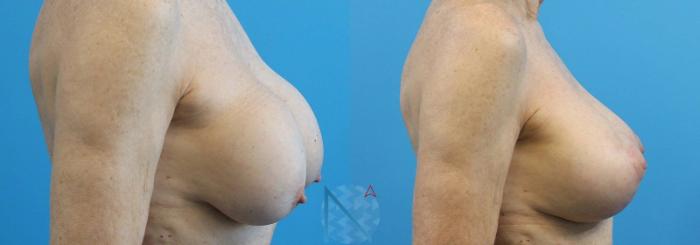 Before & After Breast Implant Revision Case 67 View 3 View in Raleigh, NC