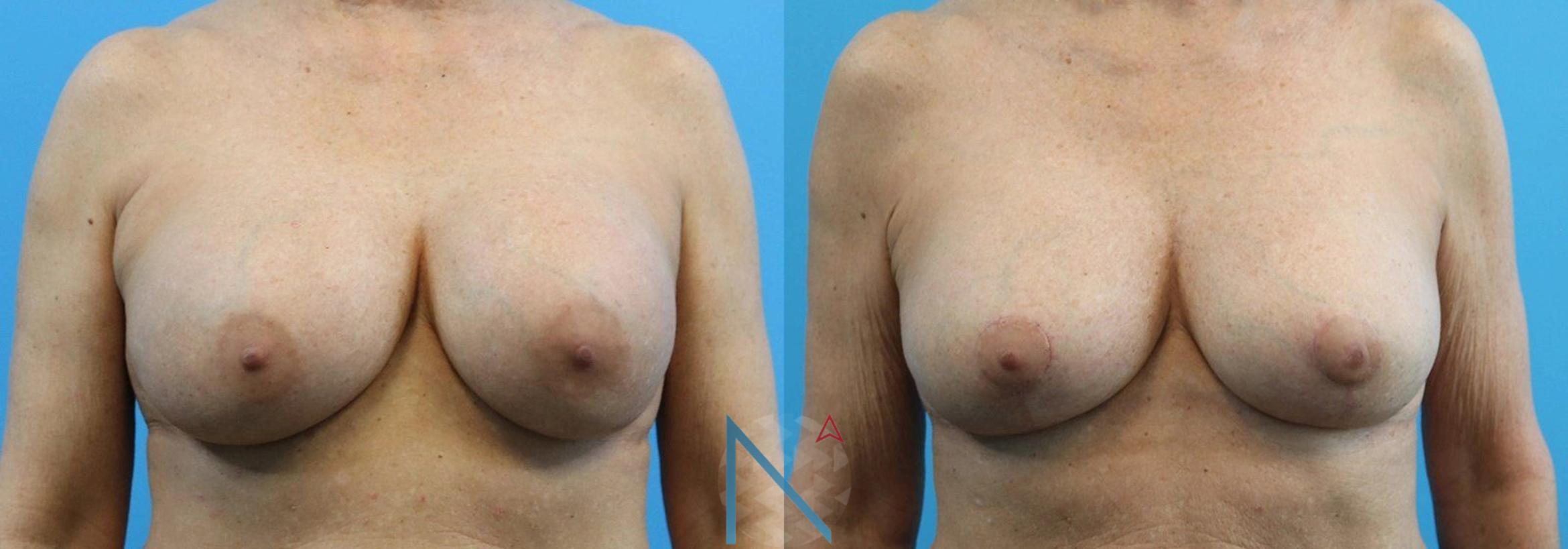 Before & After Breast Implant Revision Case 68 View 1 View in Raleigh, NC