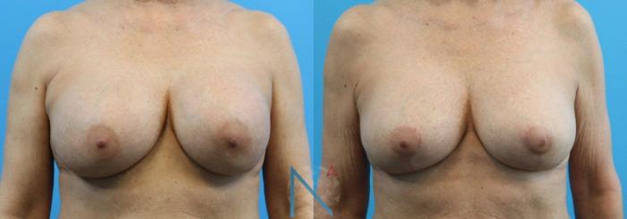 Before & After Breast Implant Revision Case 68 View 1 View in Raleigh, NC