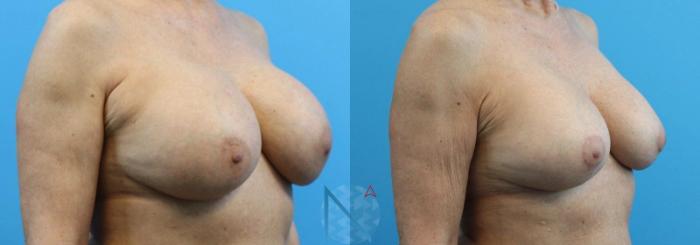 Before & After Breast Implant Revision Case 68 View 2 View in Raleigh, NC