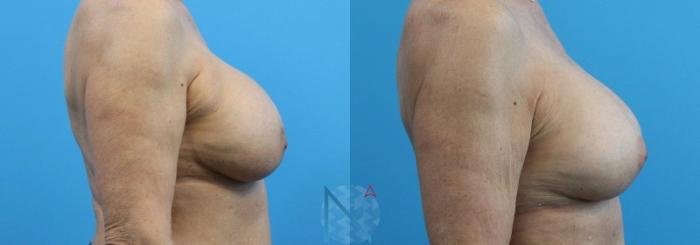 Before & After Breast Implant Revision Case 68 View 3 View in Raleigh, NC