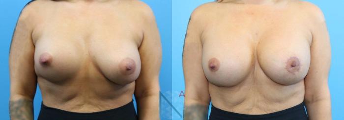 Before & After Breast Implant Revision Case 69 View 1 View in Raleigh, NC