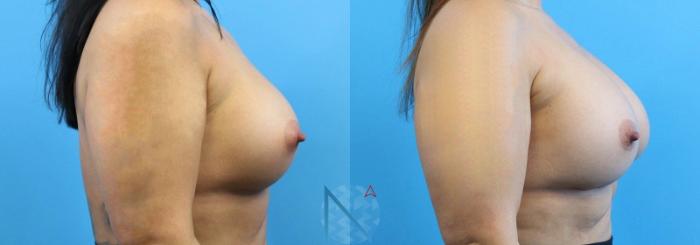 Before & After Breast Implant Revision Case 69 View 3 View in Raleigh, NC