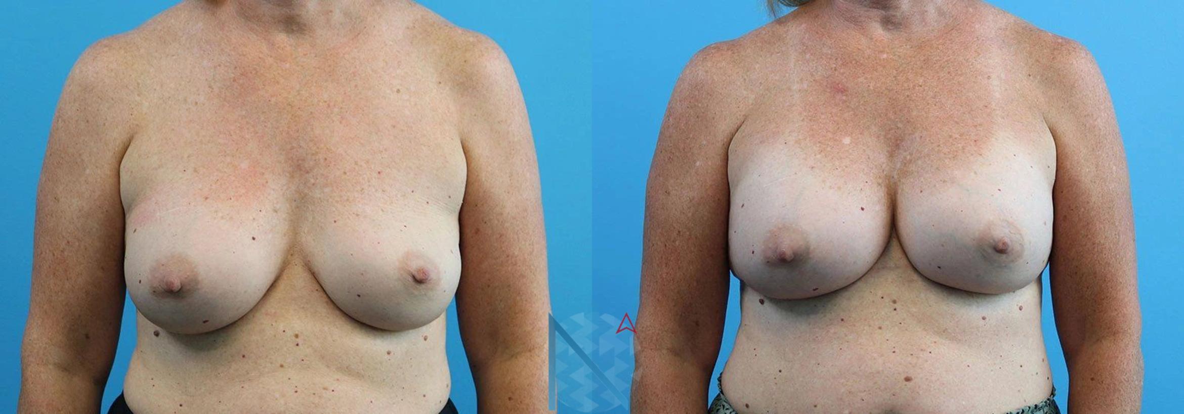 Before & After Breast Implant Revision Case 70 View 1 View in Raleigh, NC