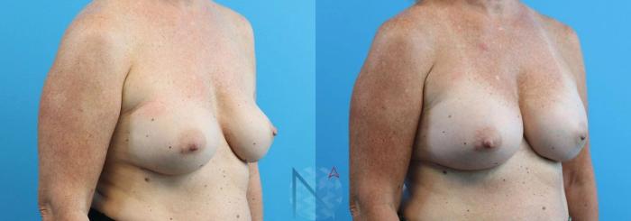 Before & After Breast Implant Revision Case 70 View 2 View in Raleigh, NC