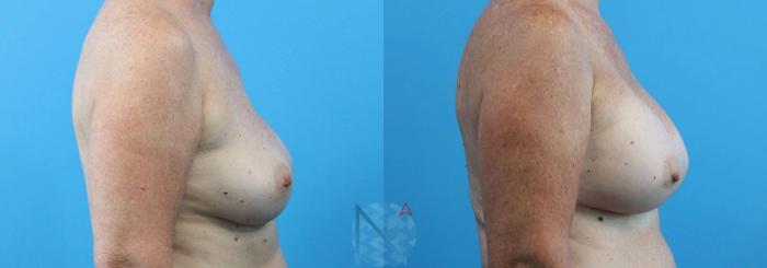 Before & After Breast Implant Revision Case 70 View 3 View in Raleigh, NC