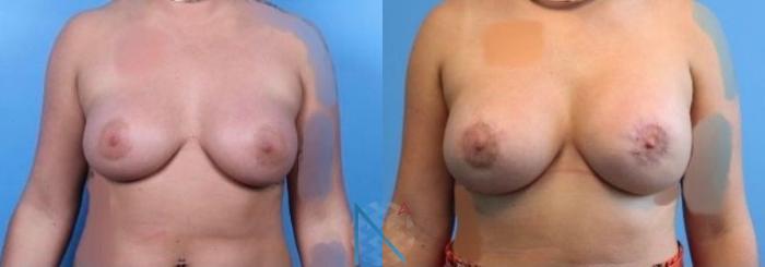 Before & After Breast Implant Revision Case 71 View 1 View in Raleigh, NC