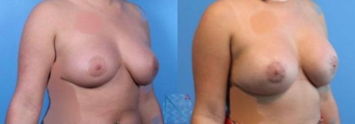 Before & After Breast Implant Revision Case 71 View 2 View in Raleigh, NC