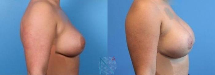 Before & After Breast Implant Revision Case 71 View 3 View in Raleigh, NC