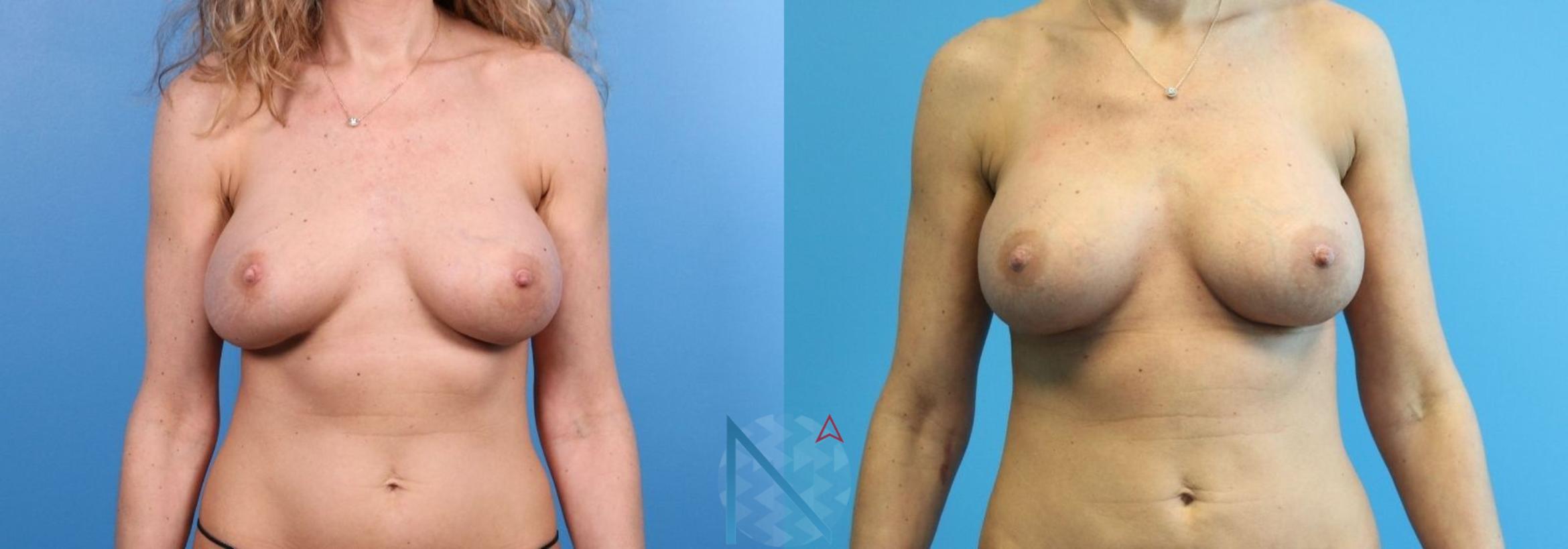 Before & After Breast Implant Revision Case 72 View 1 View in Raleigh, NC