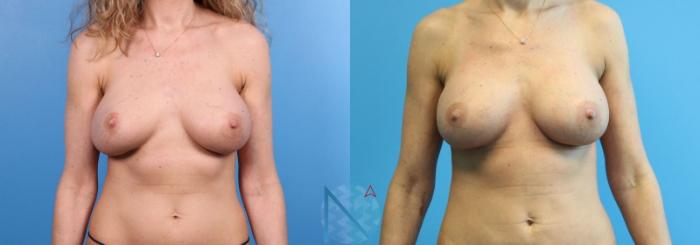 Before & After Breast Implant Revision Case 72 View 1 View in Raleigh, NC