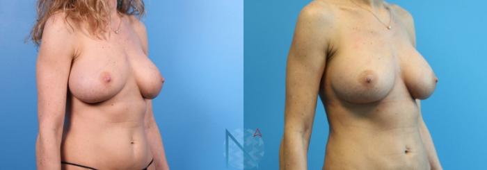 Before & After Breast Implant Revision Case 72 View 2 View in Raleigh, NC