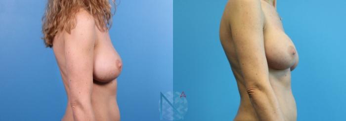 Before & After Breast Implant Revision Case 72 View 3 View in Raleigh, NC