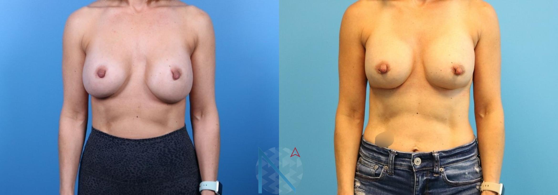 Before & After Breast Implant Revision Case 73 View 1 View in Raleigh, NC