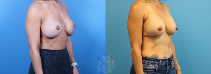 Before & After Breast Implant Revision Case 73 View 2 View in Raleigh, NC