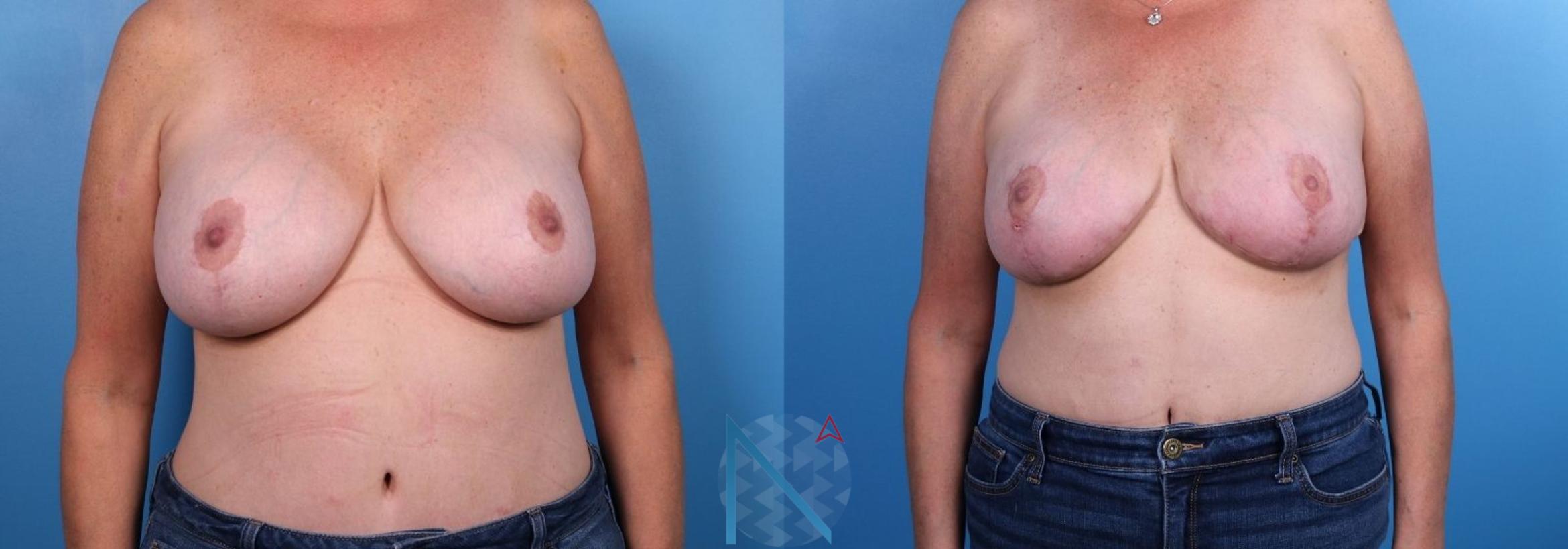 Before & After Breast Implant Revision Case 74 View 1 View in Raleigh, NC