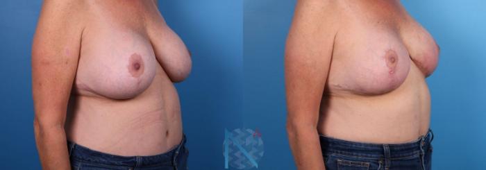 Before & After Breast Implant Revision Case 74 View 2 View in Raleigh, NC