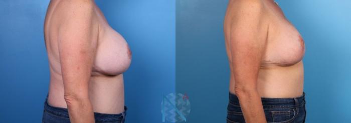 Before & After Breast Implant Revision Case 74 View 3 View in Raleigh, NC