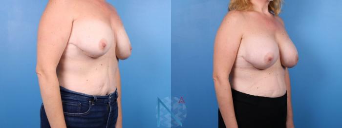 Before & After Breast Implant Revision Case 75 View 2 View in Raleigh, NC