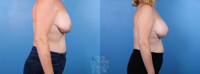 Before & After Breast Implant Revision Case 75 View 3 View in Raleigh, NC