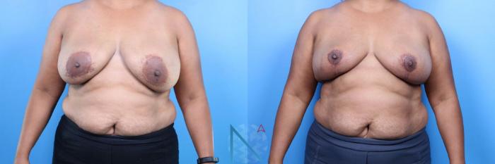 Before & After Breast Implant Revision Case 77 View 1 View in Raleigh, NC