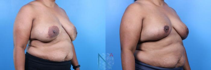 Before & After Breast Implant Revision Case 77 View 2 View in Raleigh, NC