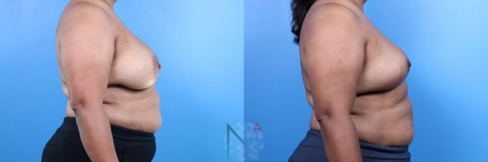 Before & After Breast Implant Revision Case 77 View 3 View in Raleigh, NC