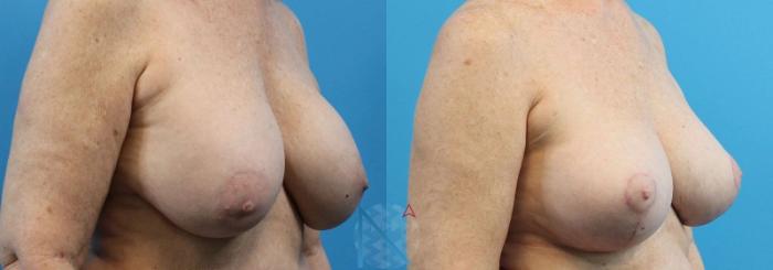 Before & After Breast Lift Case 44 View 2 View in Raleigh, NC