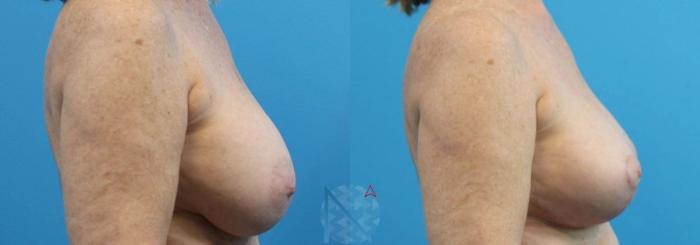 Before & After Breast Lift Case 44 View 3 View in Raleigh, NC