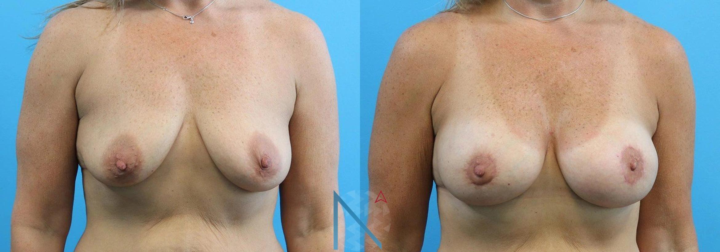 Before & After Breast Lift Case 45 View 1 View in Raleigh, NC