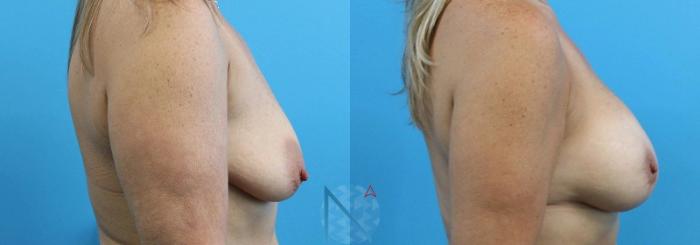 Before & After Breast Lift Case 45 View 3 View in Raleigh, NC