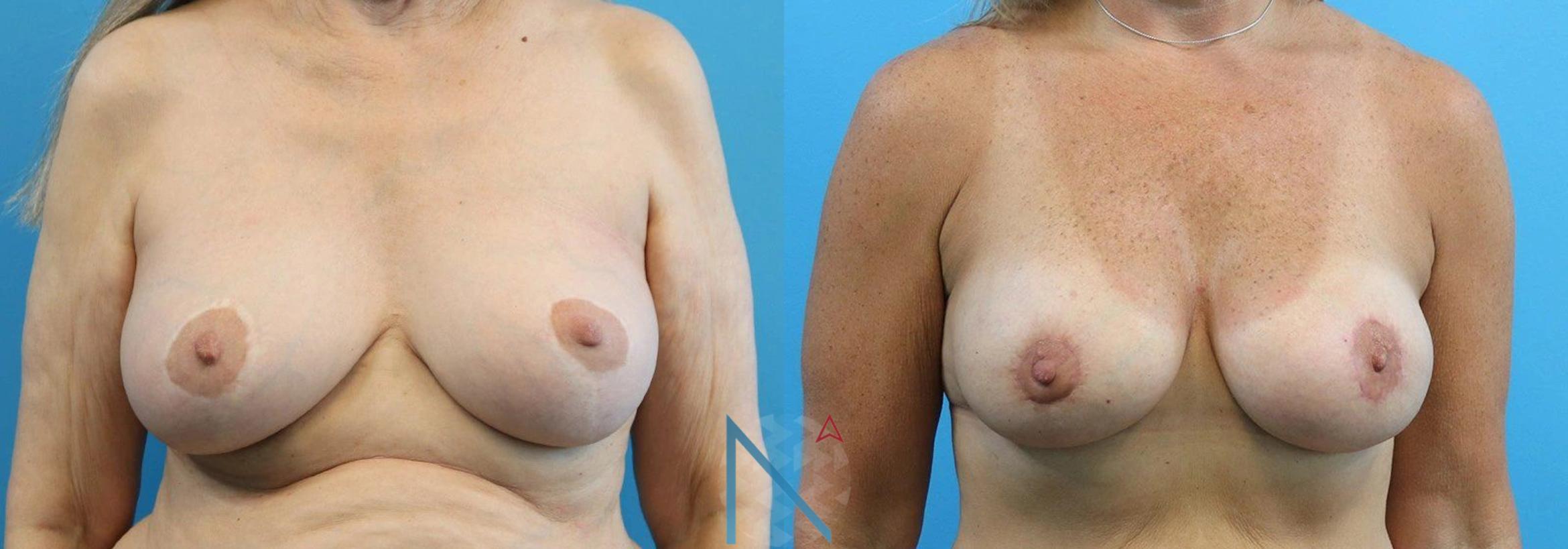 Before & After Breast Lift Case 46 View 1 View in Raleigh, NC