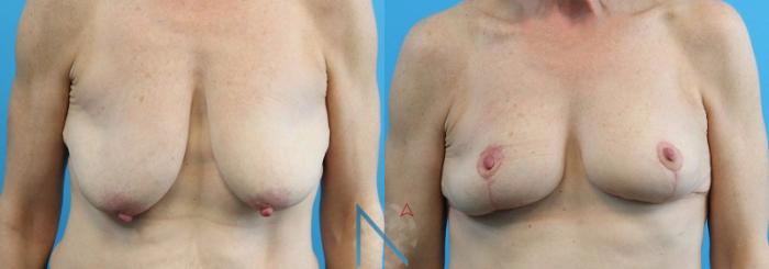 Before & After Breast Lift Case 48 View 1 View in Raleigh, NC